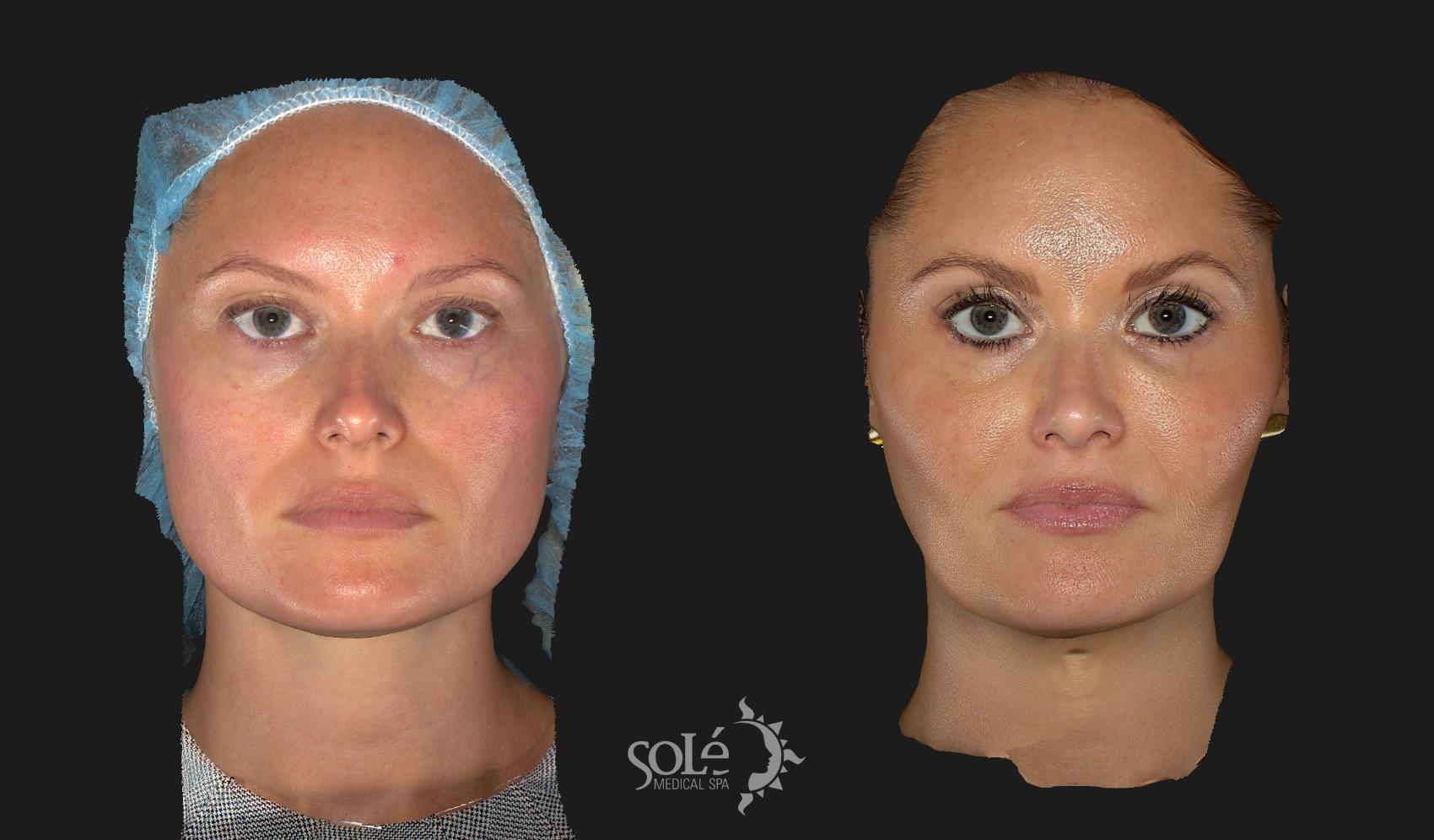 BOTOX® & Dysport® Case 10 Before & After Front | Tifton, GA | Solé Medical Spa