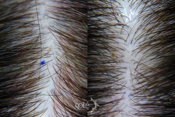 Before & After The Epic Hair Program Case 112 Scalp View in Tifton, Albany & Valdosta, GA