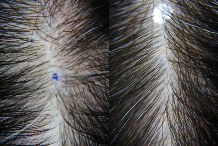 Before & After The Epic Hair Program Case 113 Scalp View in Tifton, Albany & Valdosta, GA