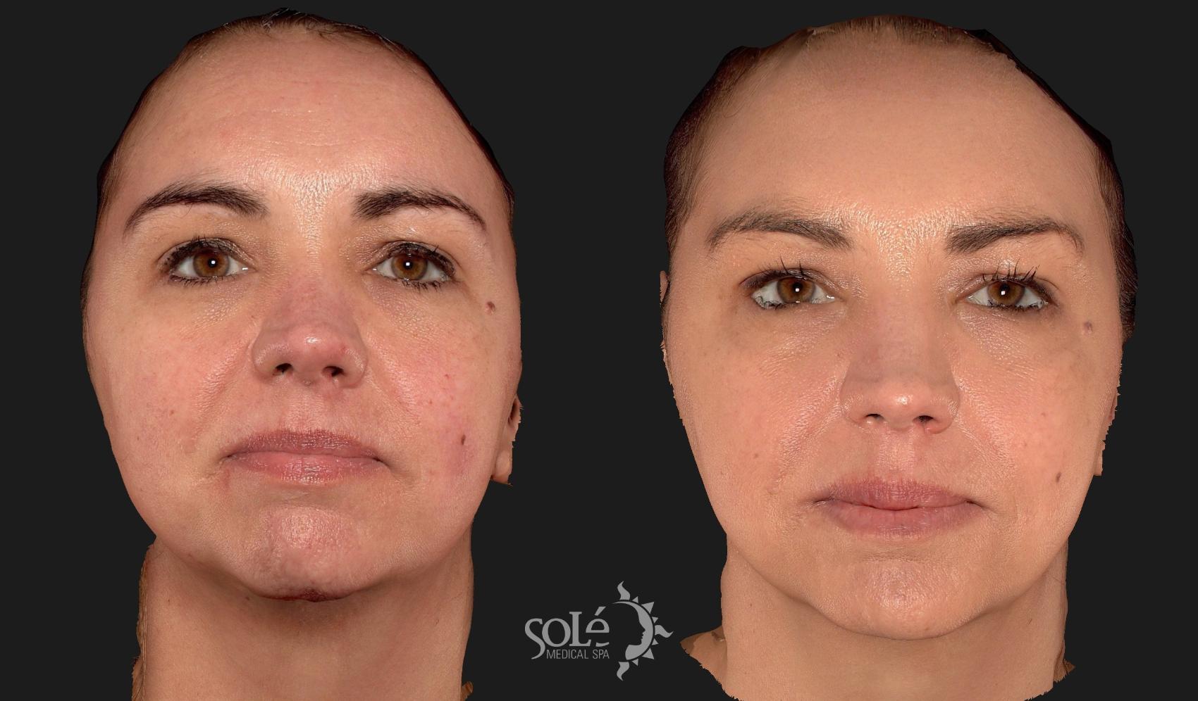 Before & After BOTOX® & Dysport® Case 105 Front View in Tifton, GA