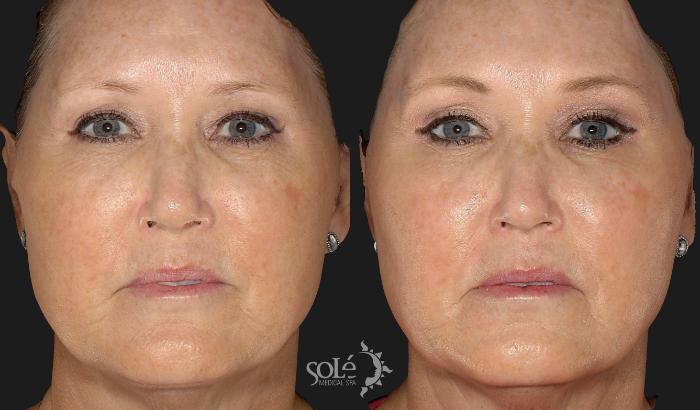 Before & After BOTOX® & Dysport® Case 16 Front View in Tifton, GA