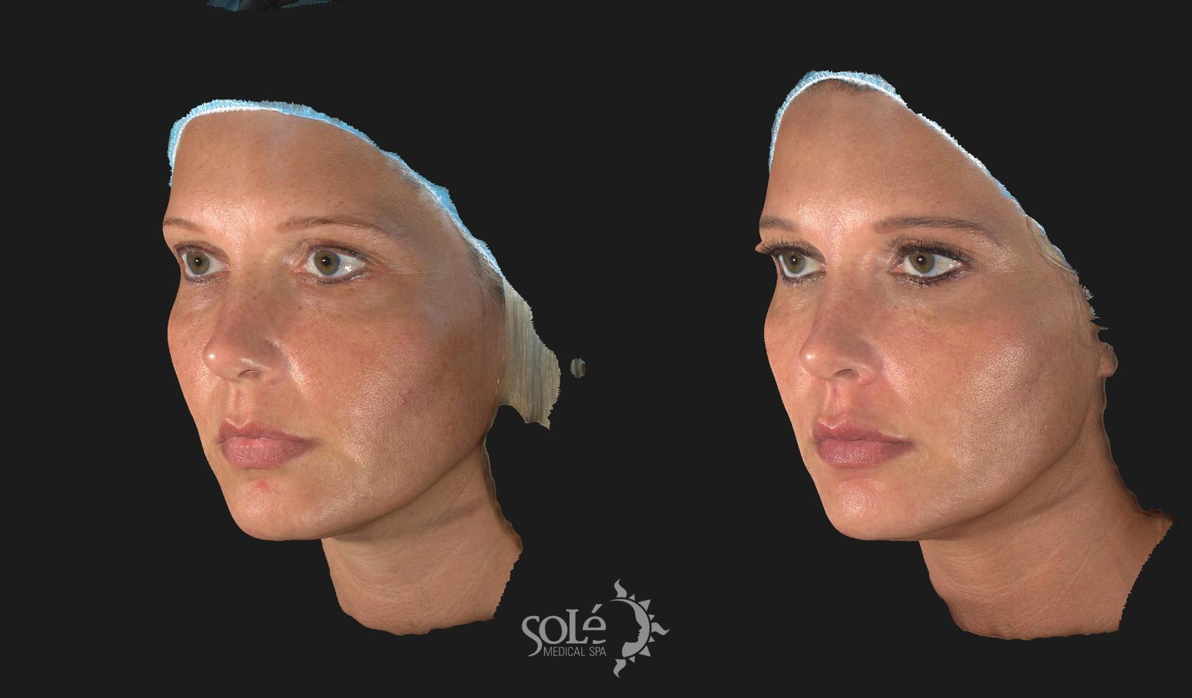 Before & After BOTOX® & Dysport® Case 31 Left Oblique View in Tifton, GA