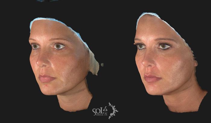 Before & After BOTOX® & Dysport® Case 31 Left Oblique View in Tifton, GA