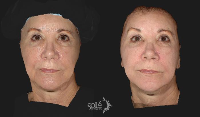 Before & After BOTOX® & Dysport® Case 56 Front View in Tifton, GA
