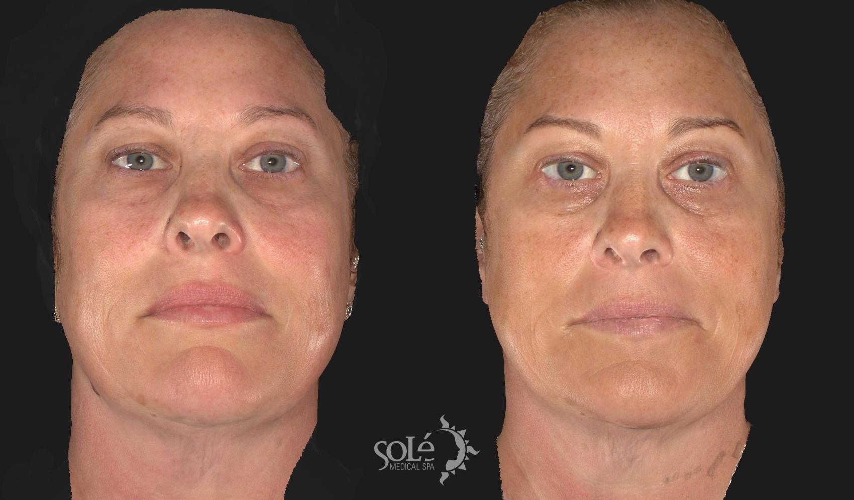 Before & After BOTOX® & Dysport® Case 61 Front View in Tifton, GA