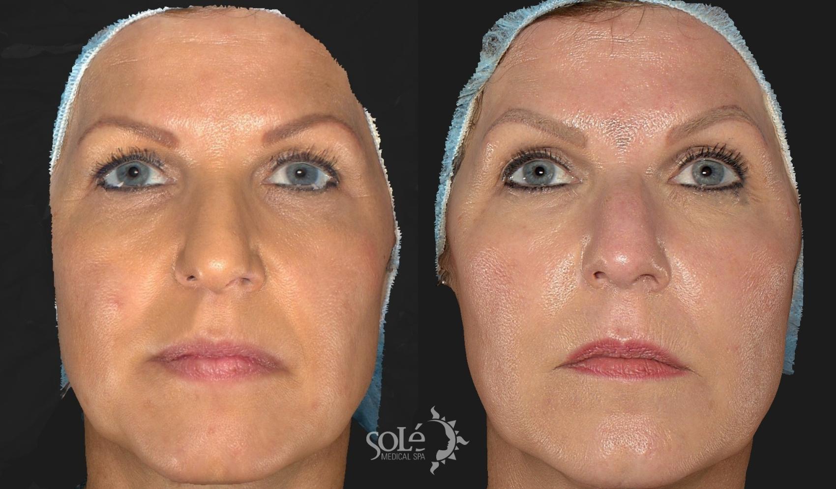 Dysport® & BOTOX® Cosmetic in Tifton, South Georgia