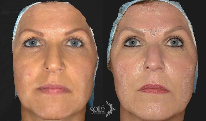 Before & After BOTOX® & Dysport® Case 64 Front View in Tifton, GA