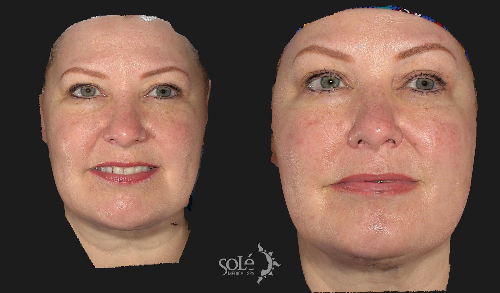 Botox® And Dysport® Before And After Pictures Case 67 Tifton Albany And Valdosta Ga Solé 2041