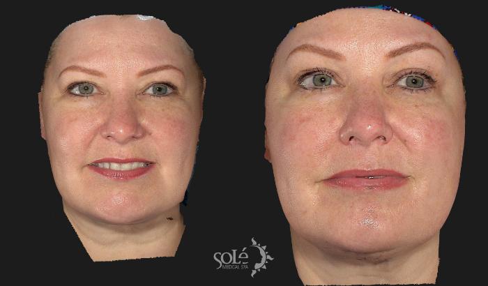 Before & After BOTOX® & Dysport® Case 67 Front View in Tifton, GA