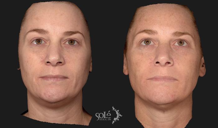 Before & After Dermal Fillers Case 102 Front View in Tifton, GA