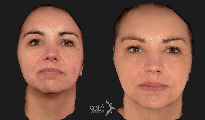 Before & After Dermal Fillers Case 107 Front View in Tifton, GA