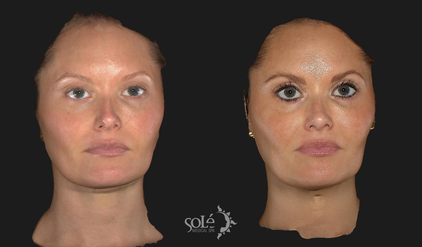 Before & After Dermal Fillers Case 11 Front View in Tifton, GA