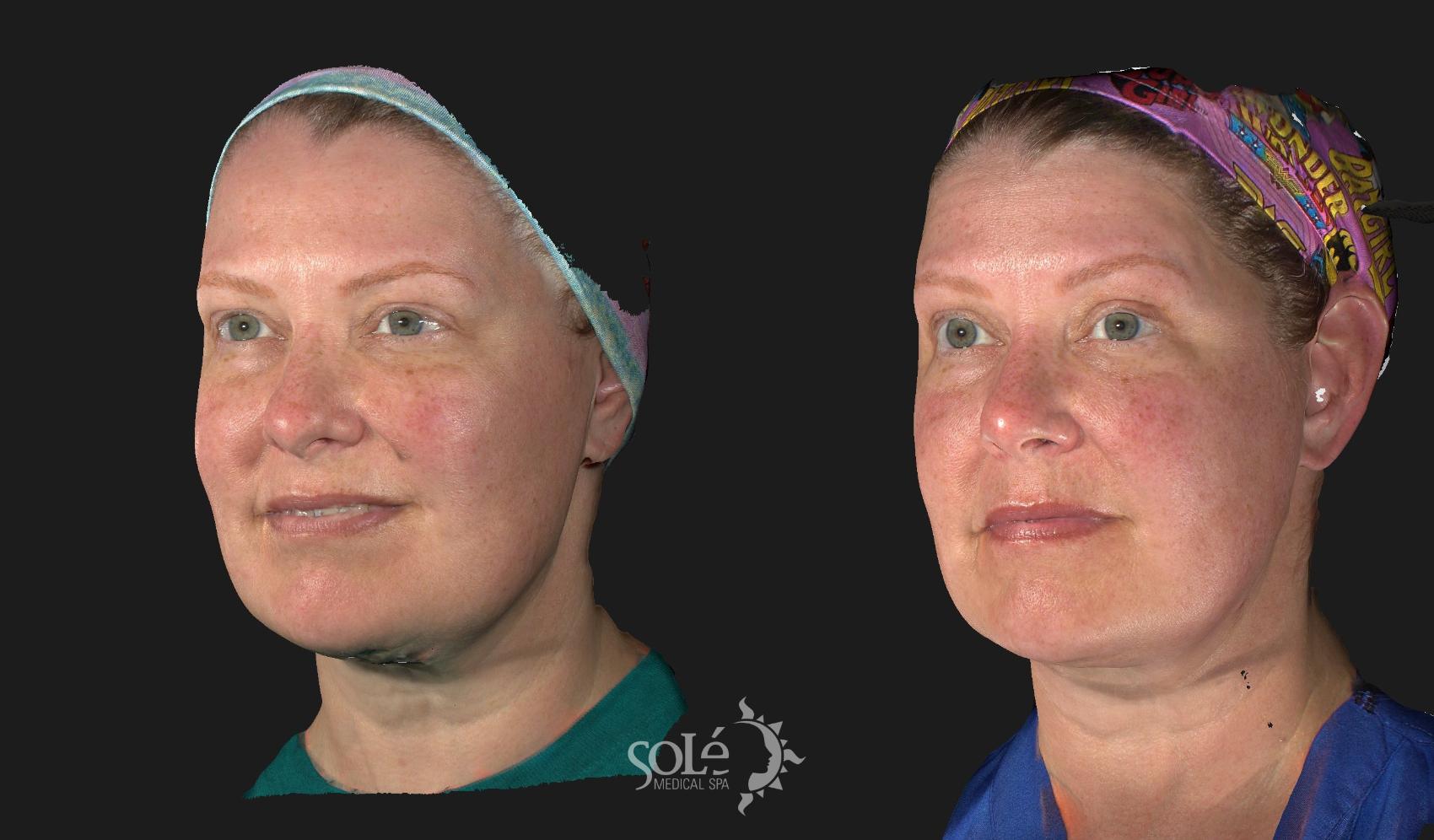 Before & After Dermal Fillers Case 14 Left Oblique View in Tifton, GA