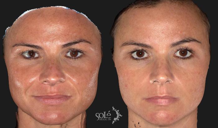 Before & After Dermal Fillers Case 20 Front View in Tifton, GA