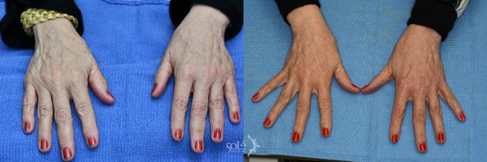 Before & After Laser Skin Rejuvenation Case 21 Hands View in Tifton, GA