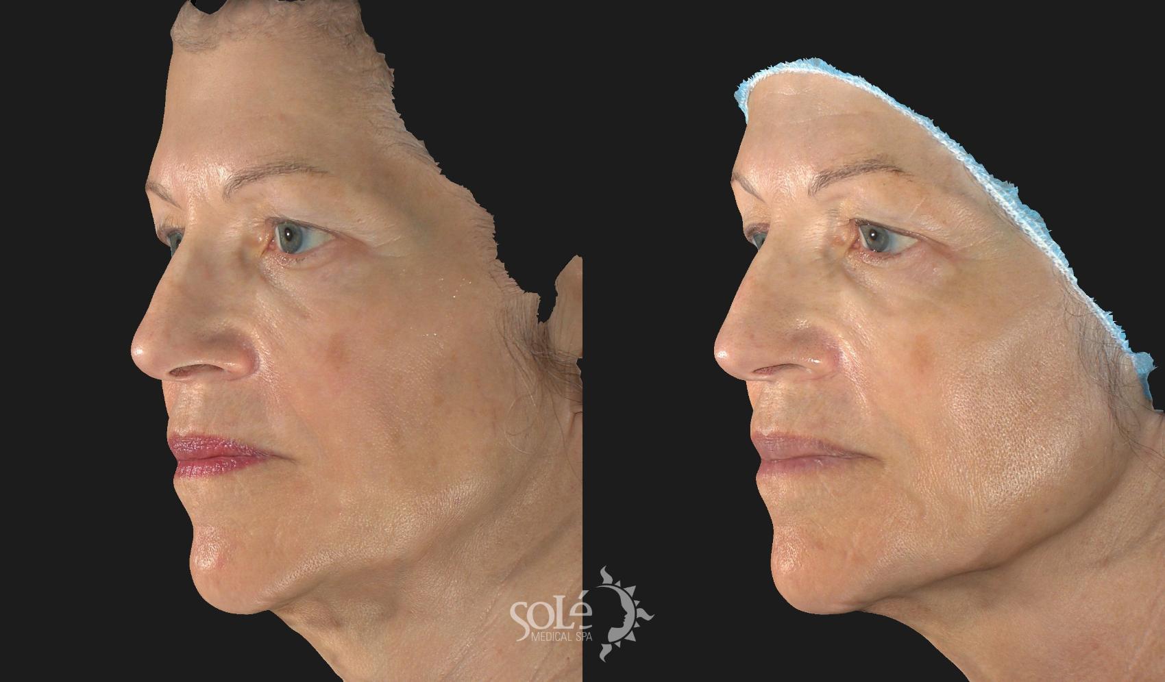 Before & After Dermal Fillers Case 25 Left Side View in Tifton, GA