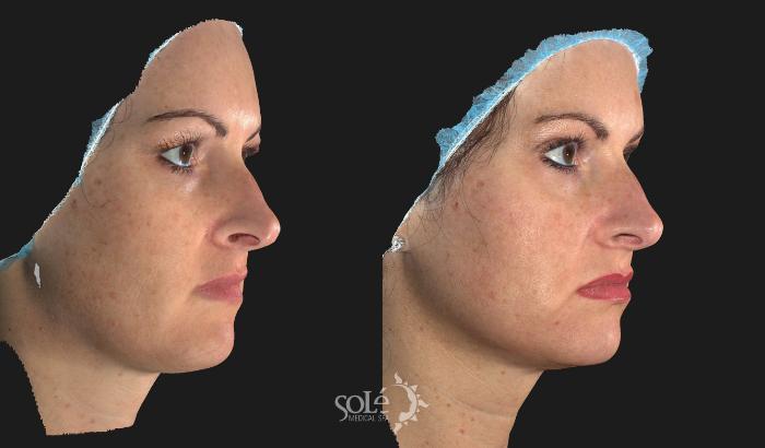 Before & After Dermal Fillers Case 26 Right Oblique View in Tifton, GA