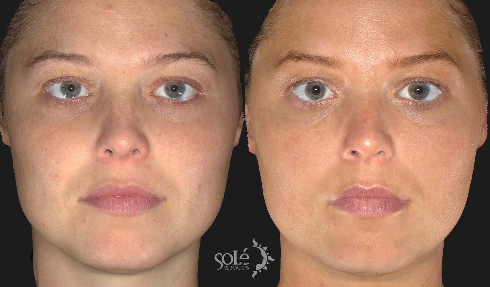 Before & After Dermal Fillers Case 27 Front View in Tifton, GA