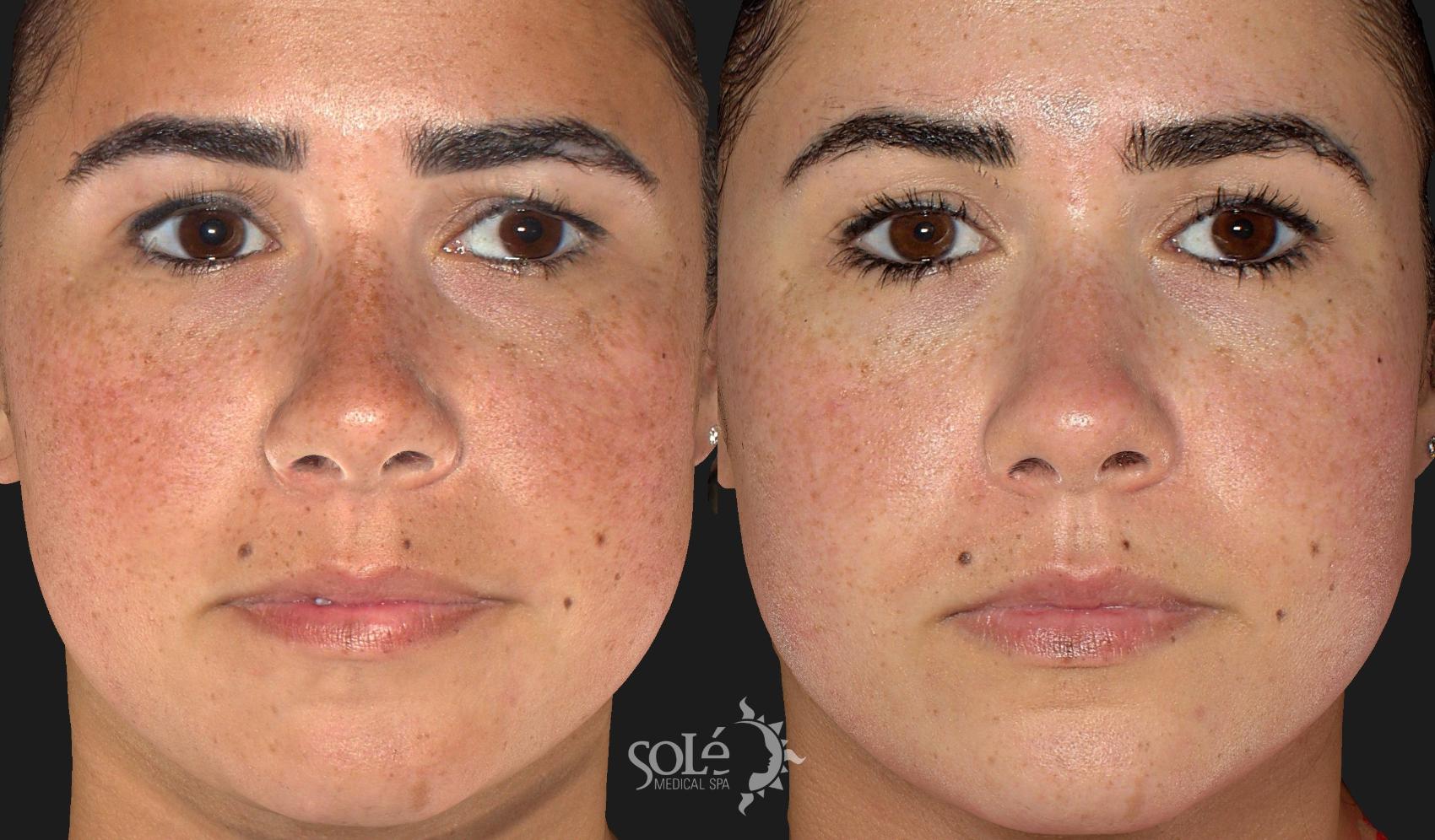 Before & After Dermal Fillers Case 28 Front View in Tifton, GA