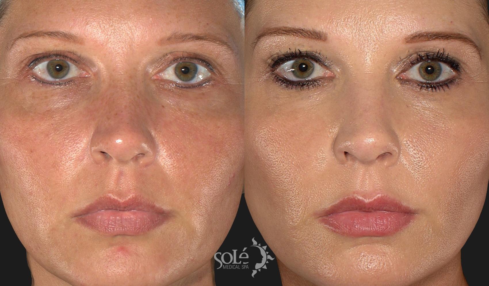 Before & After Dermal Fillers Case 32 Front View in Tifton, GA