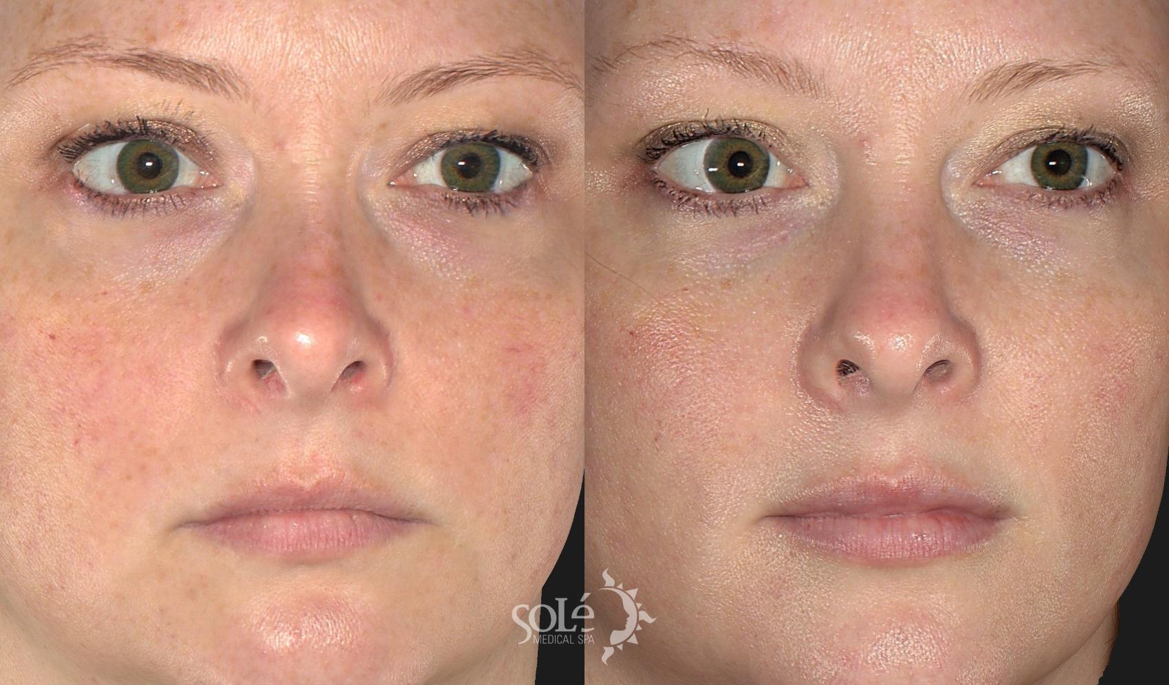 Before & After Dermal Fillers Case 34 Front View in Tifton, GA