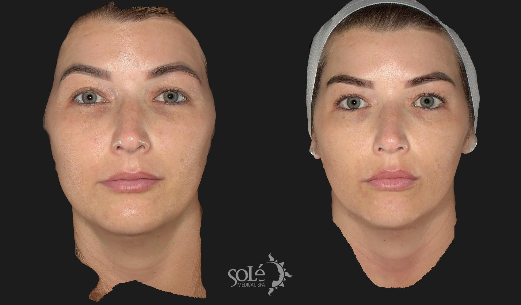 Before & After Dermal Fillers Case 48 Front View in Tifton, GA