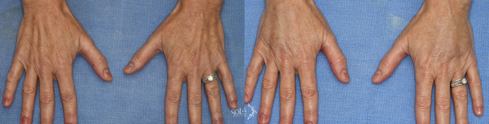 Before & After Dermal Fillers Case 52 Hands View in Tifton, GA