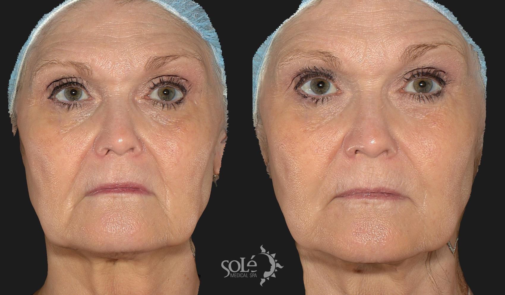 Before & After Dermal Fillers Case 54 Front View in Tifton, GA
