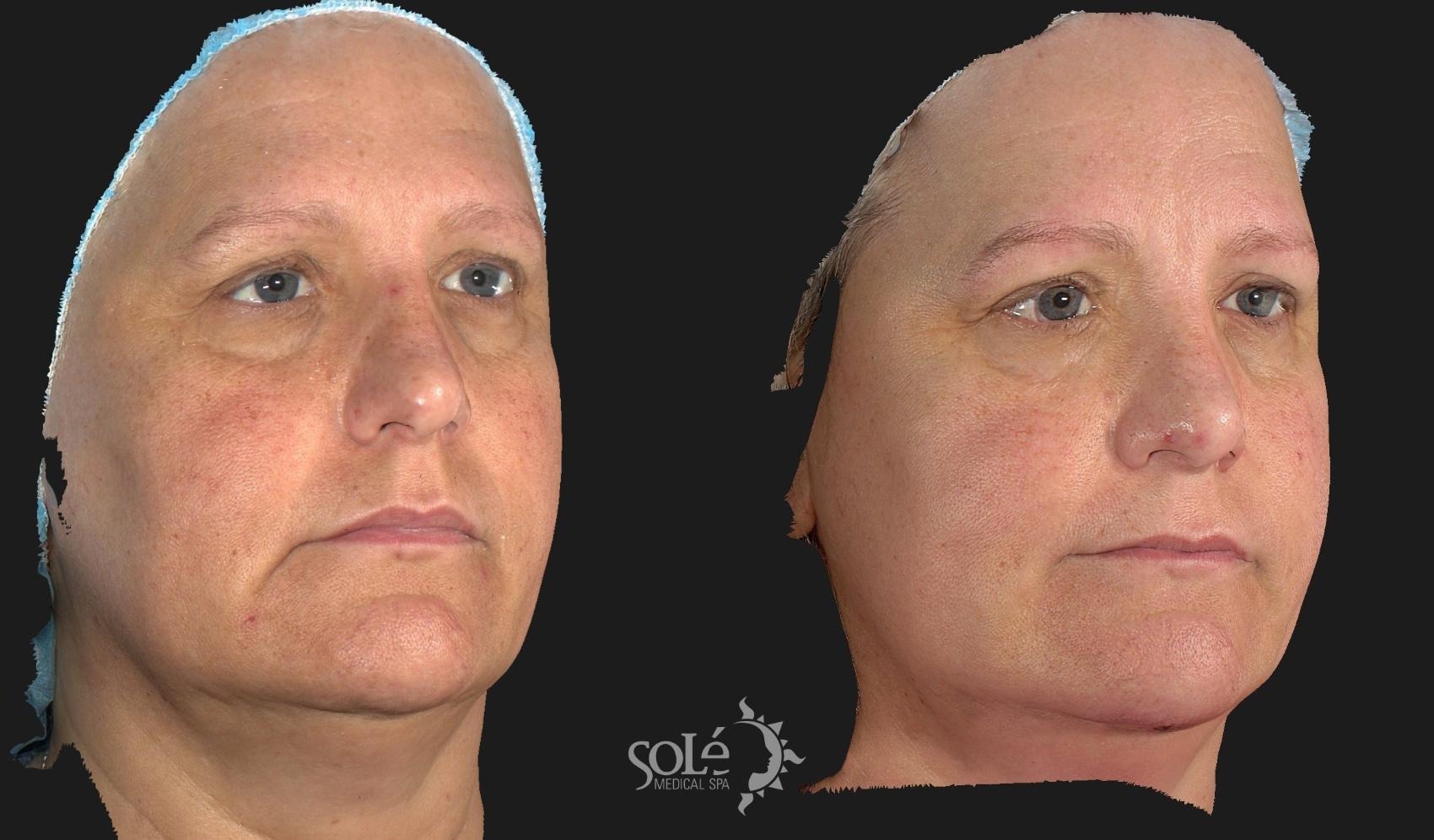 Before & After Dermal Fillers Case 57 Right Oblique View in Tifton, GA