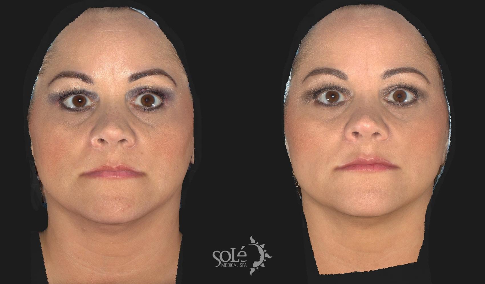 Before & After Dermal Fillers Case 59 Front View in Tifton, GA