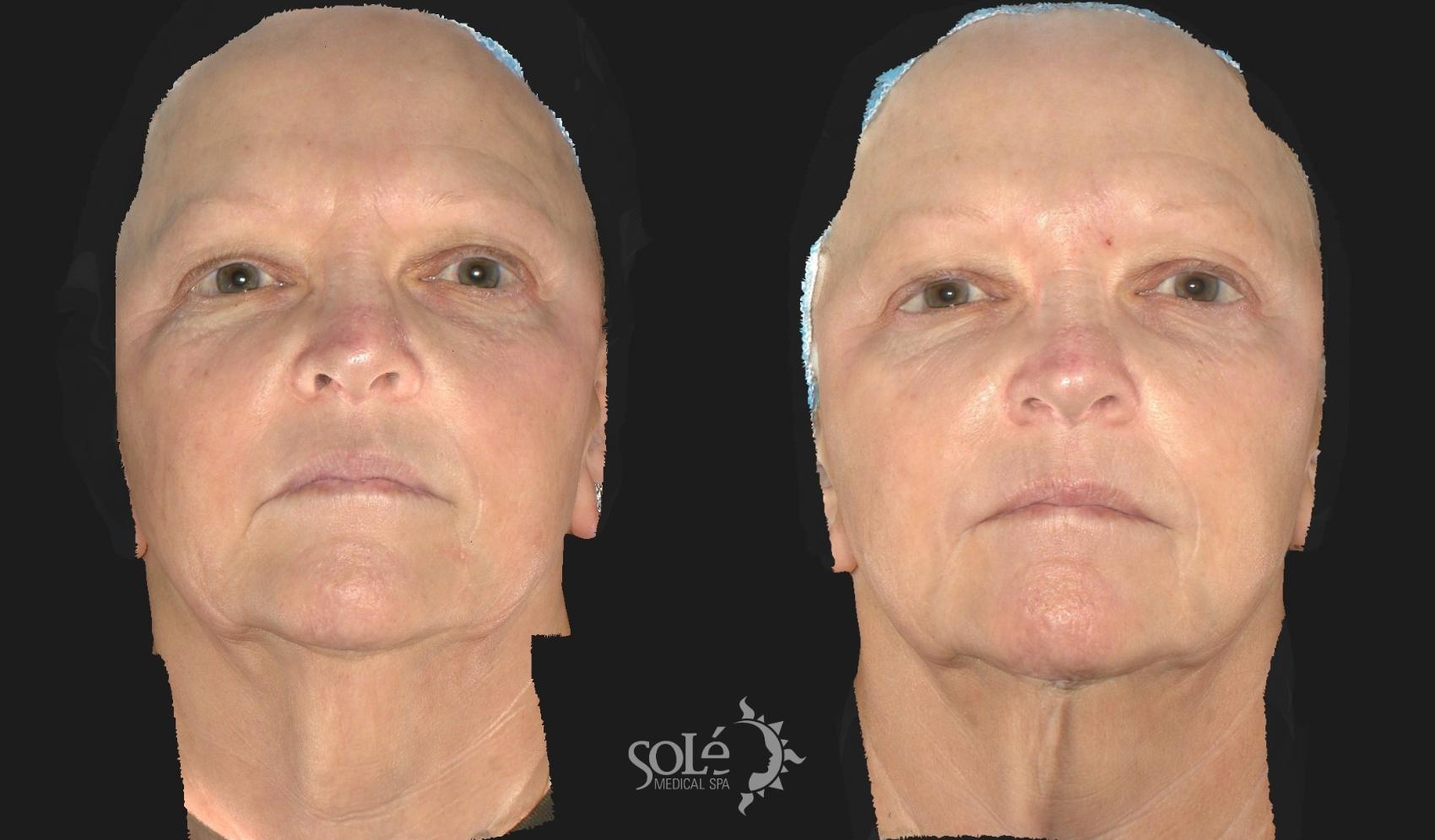 Before & After Dermal Fillers Case 60 Front View in Tifton, GA