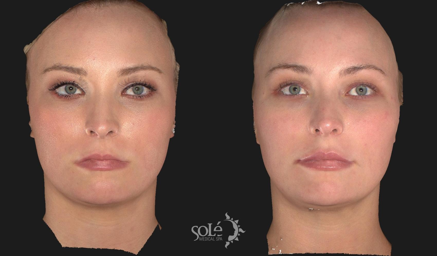 Before & After Dermal Fillers Case 63 Front View in Tifton, GA