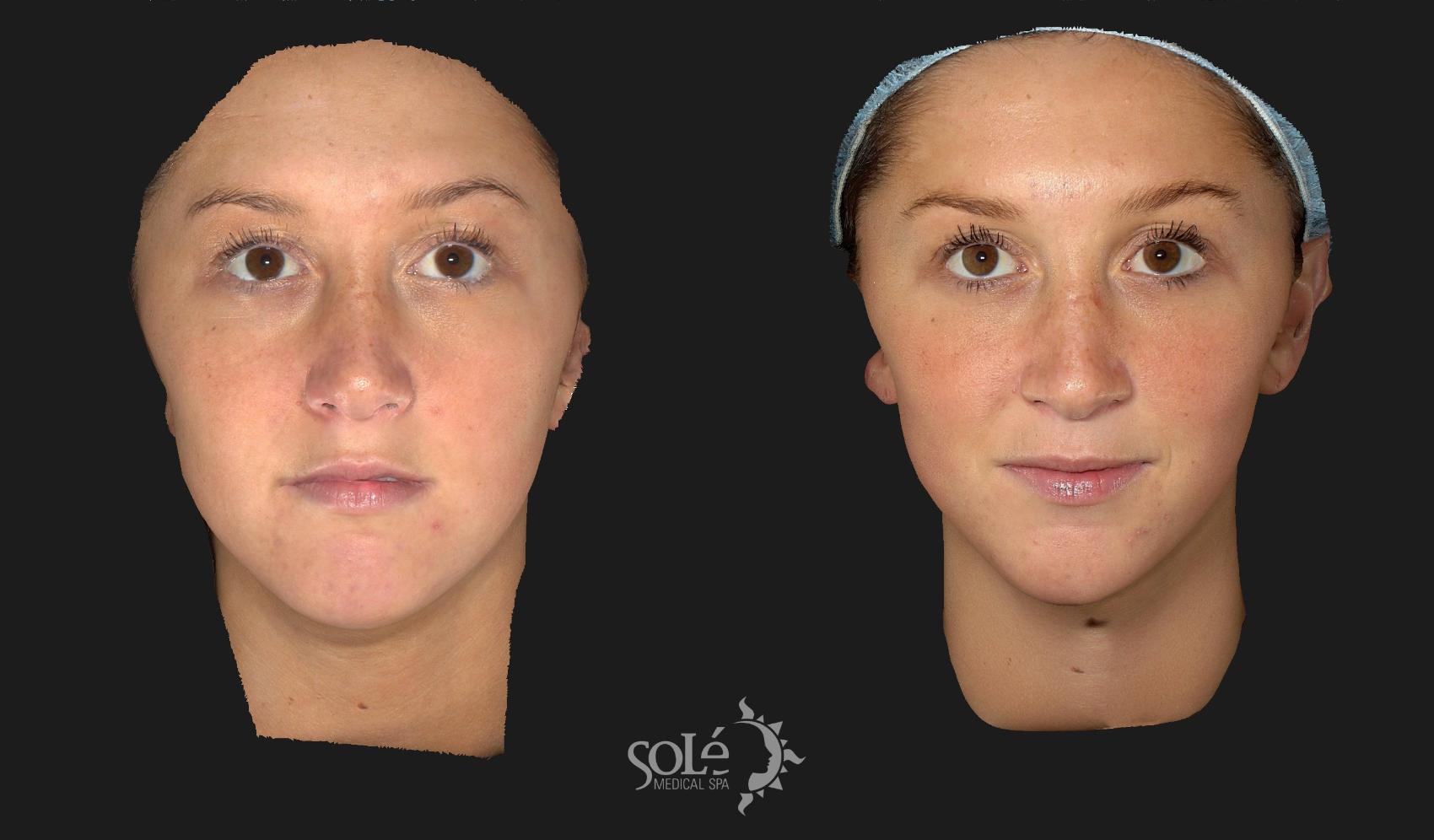 Before & After Dermal Fillers Case 65 Front View in Tifton, GA