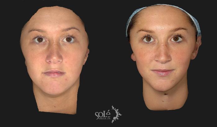 Before & After Dermal Fillers Case 65 Front View in Tifton, GA