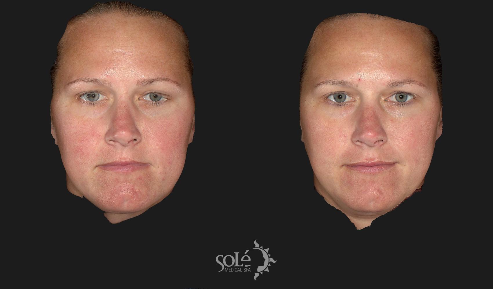 Before & After Dermal Fillers Case 66 Front View in Tifton, GA