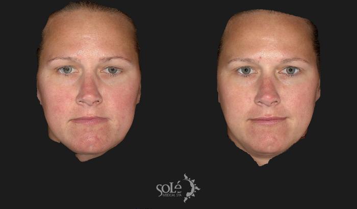 Before & After Dermal Fillers Case 66 Front View in Tifton, GA