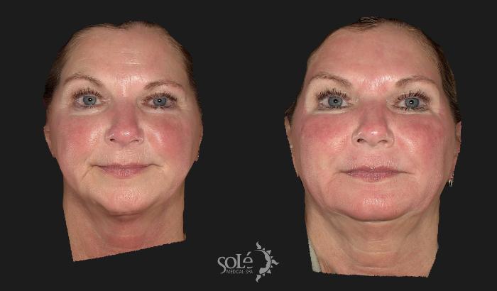 Before & After Dermal Fillers Case 68 Front View in Tifton, GA