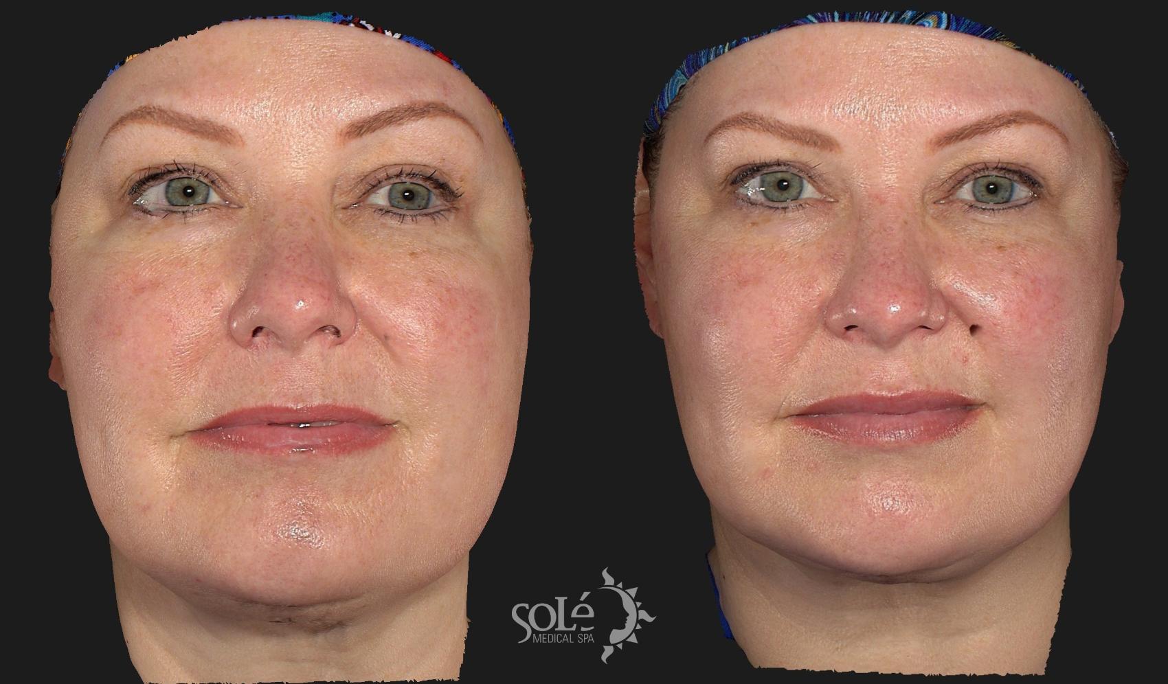 Before & After Dermal Fillers Case 69 Front View in Tifton, GA
