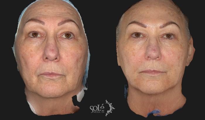 Before & After Dermal Fillers Case 70 Front View in Tifton, GA