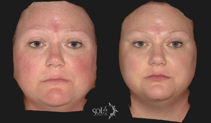 Before & After Dermal Fillers Case 73 Front View in Tifton, GA