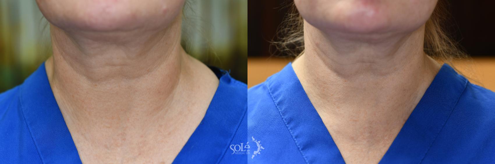 Before & After Dermal Fillers Case 79 Front View in Tifton, GA