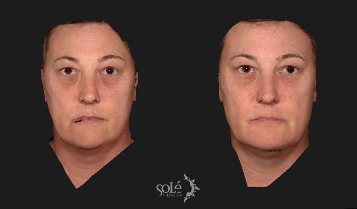 Before & After Dermal Fillers Case 80 Front View in Tifton, GA