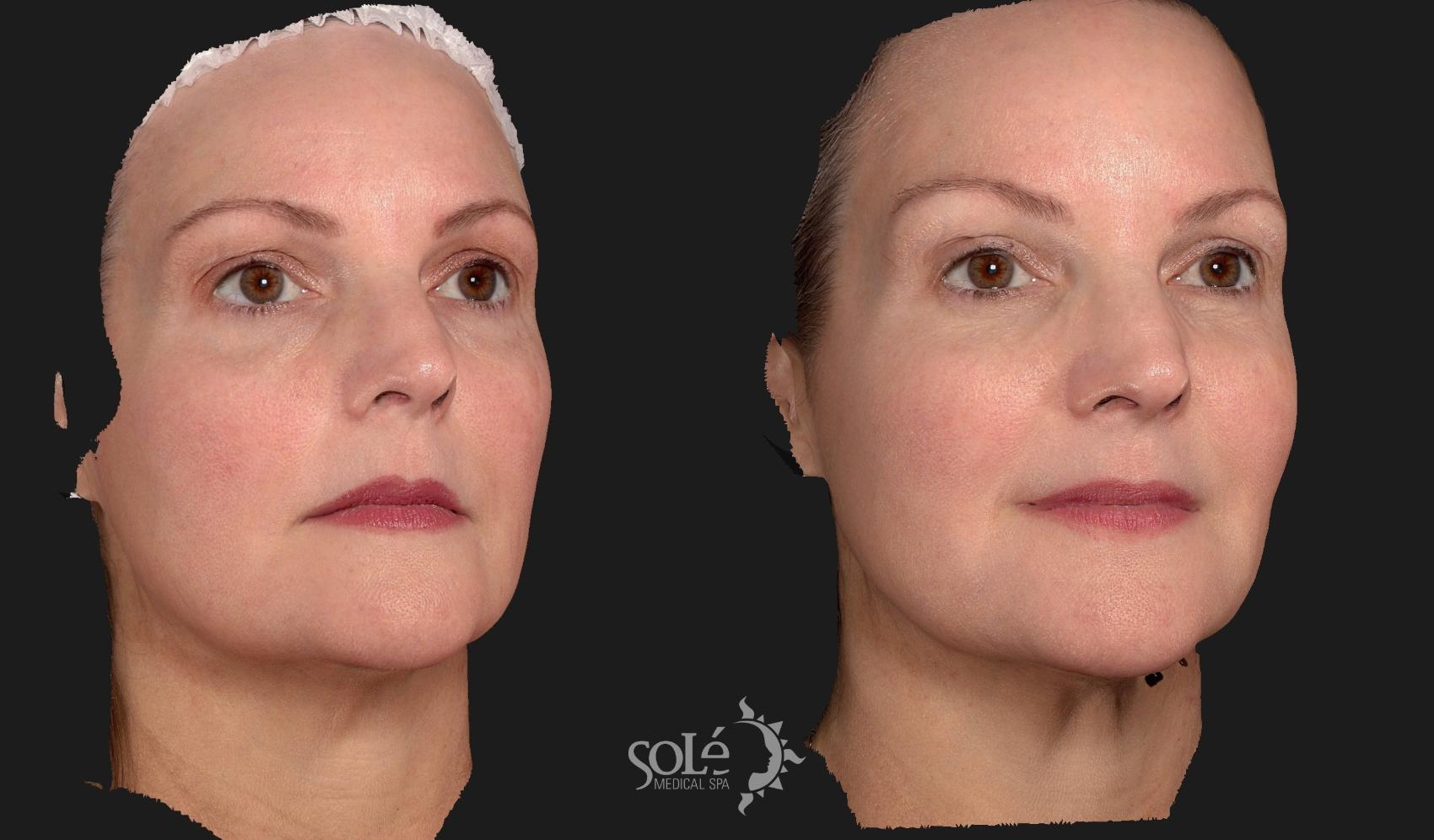 Before & After Dermal Fillers Case 84 Right Side View in Tifton, GA