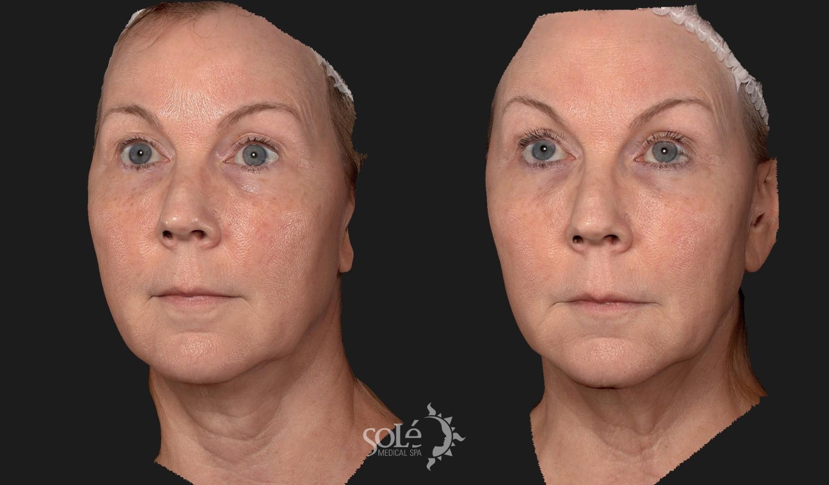 Before & After Dermal Fillers Case 86 Left Oblique View in Tifton, GA