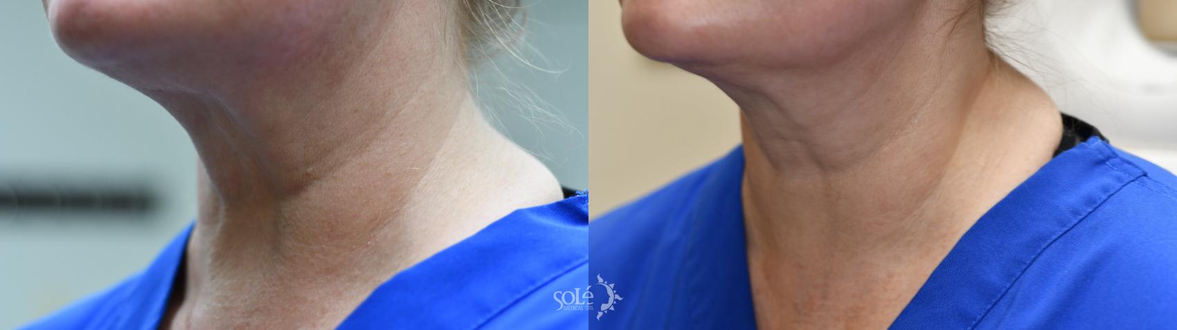 Before & After Dermal Fillers Case 88 Left Side View in Tifton, GA