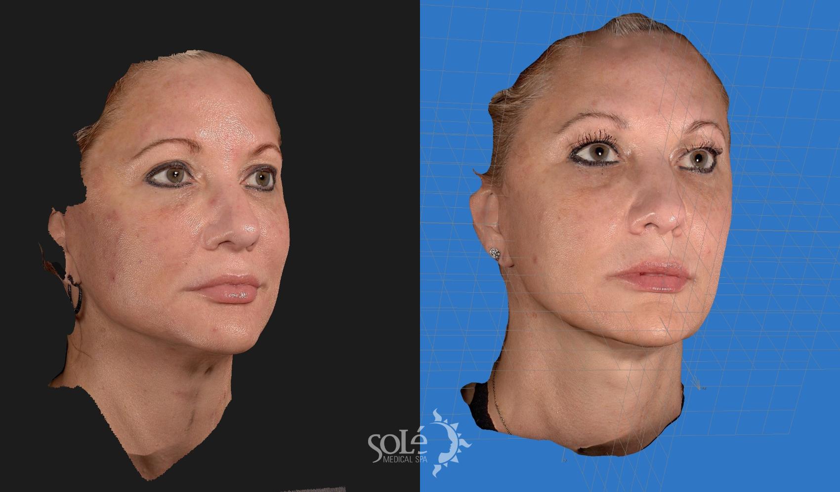 Before & After Dermal Fillers Case 89 Right Oblique View in Tifton, GA