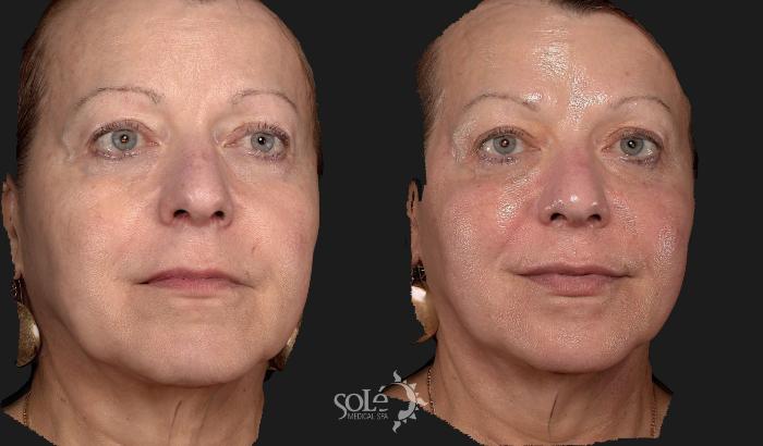 Before & After Dermal Fillers Case 91 Right Oblique View in Tifton, GA