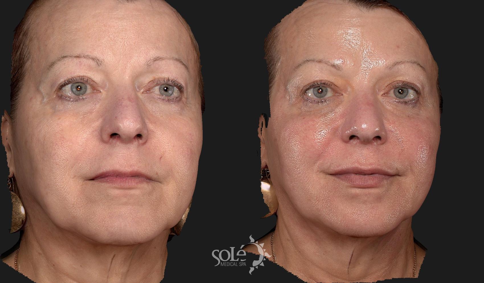 Before & After Dermal Fillers Case 92 Right Oblique View in Tifton, GA