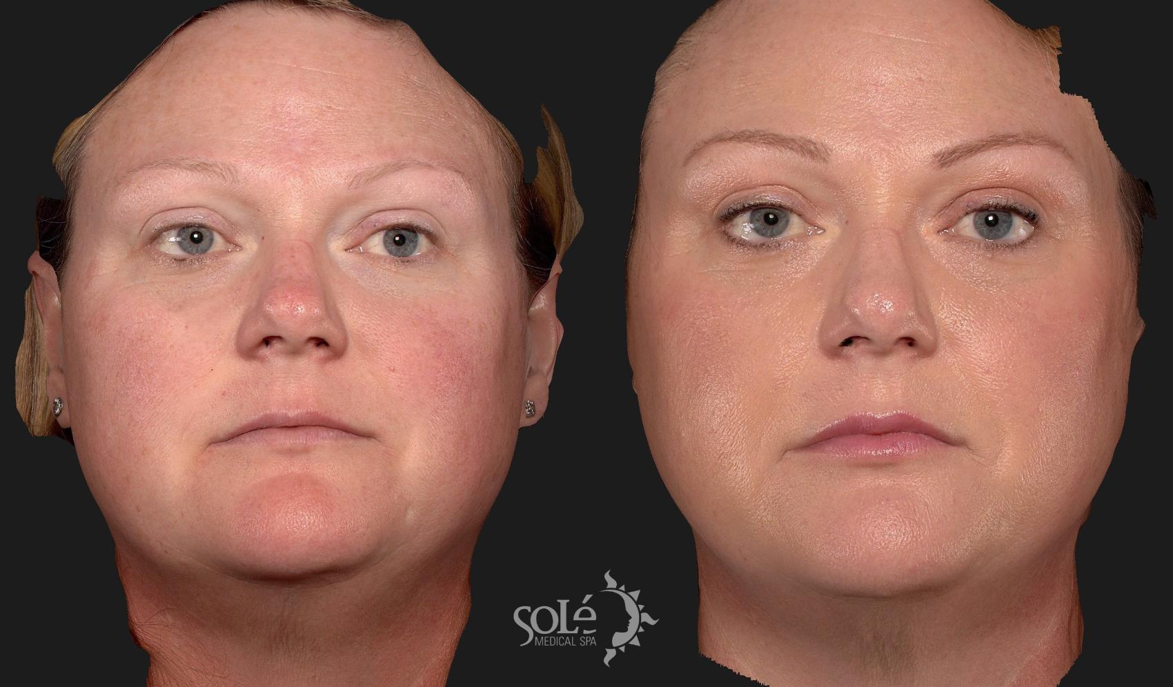 Before & After Dermal Fillers Case 98 Front View in Tifton, GA