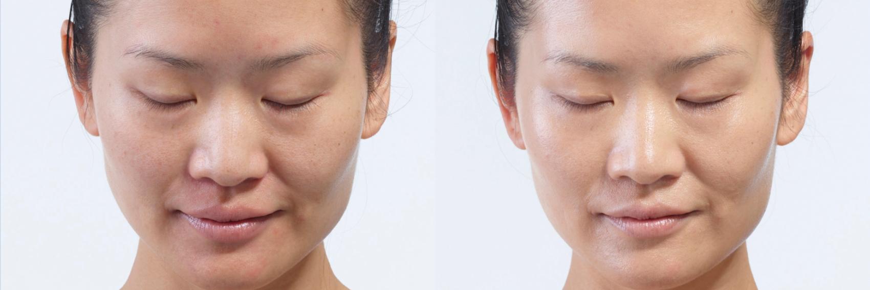 Before picture shows a woman's face with normal acne. After picture shows visibly brighter and glowing skin.